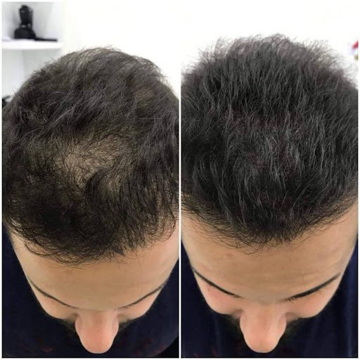 hair transplantation before & after image